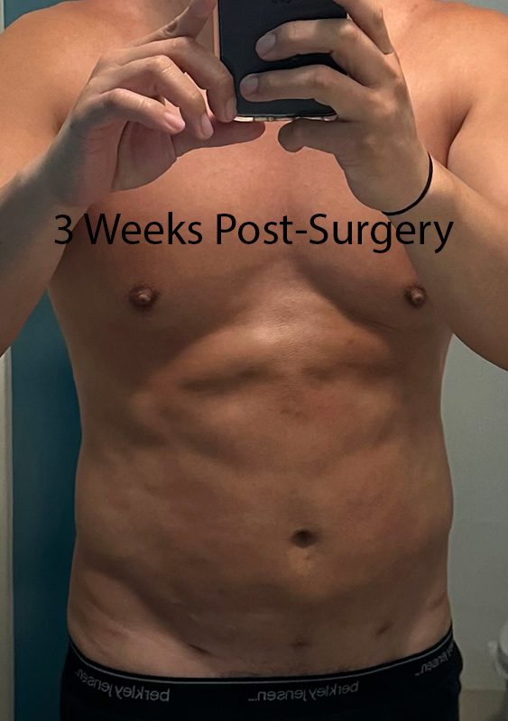 Abdomen Liposuction Before & After Image