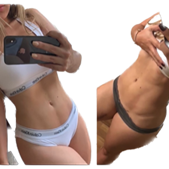 Vaser Liposuction Before & After Image