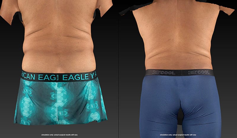 Vaser Liposuction Before & After Image