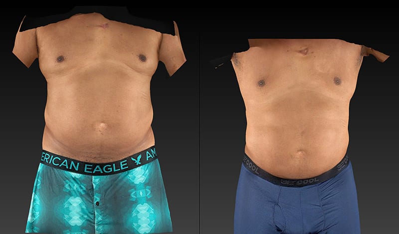 Abdomen Liposuction Before & After Image