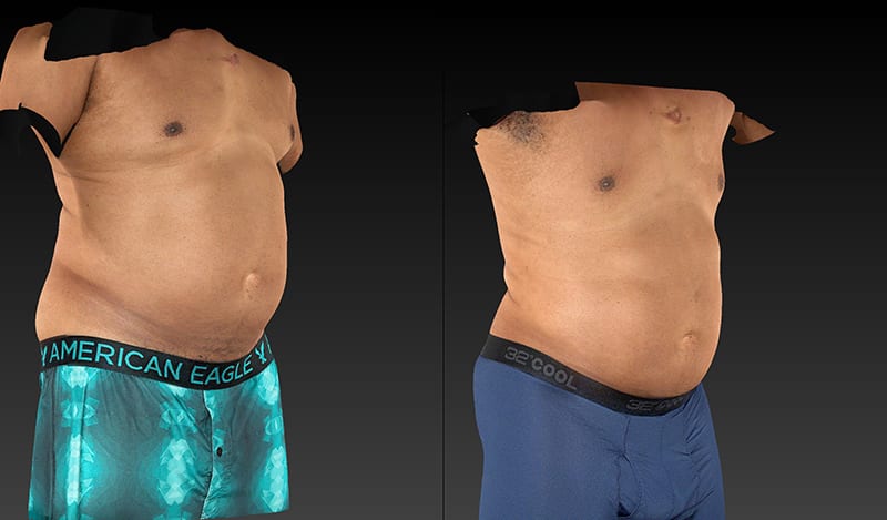 Abdomen Liposuction Before & After Image