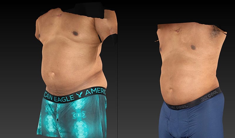 Abdomen Liposuction Before & After Image