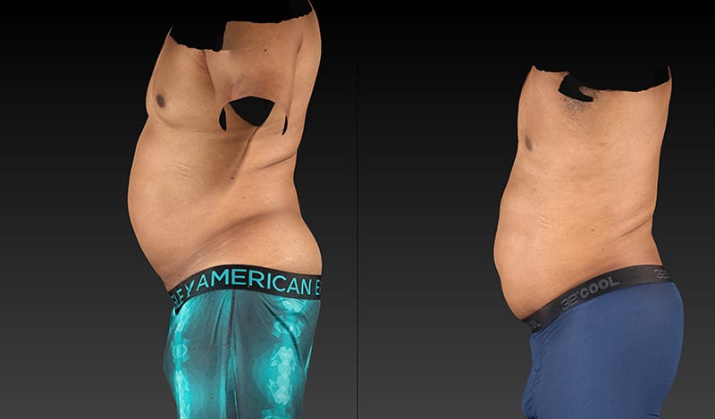 Vaser Liposuction Before & After Image