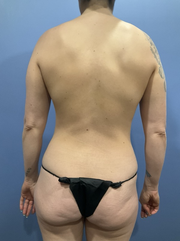 Vaser Liposuction Before & After Image