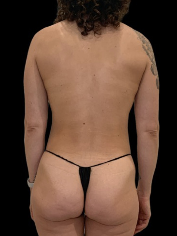 Vaser Liposuction Before & After Image