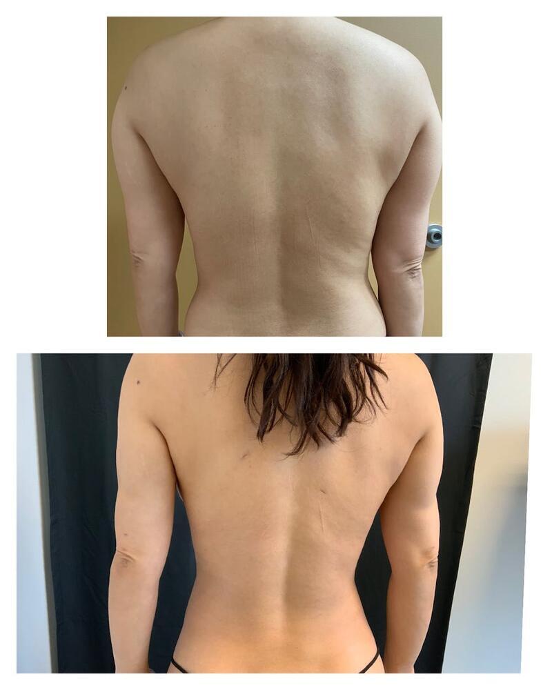 Arm Liposuction Before & After Image