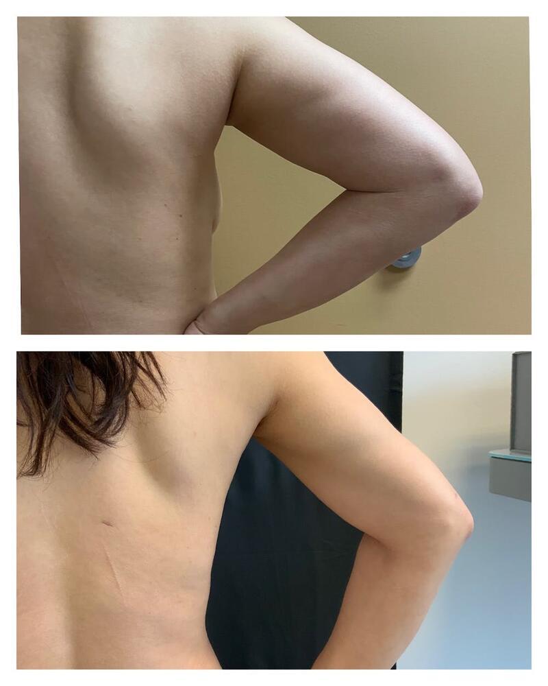 Arm Liposuction Before & After Image