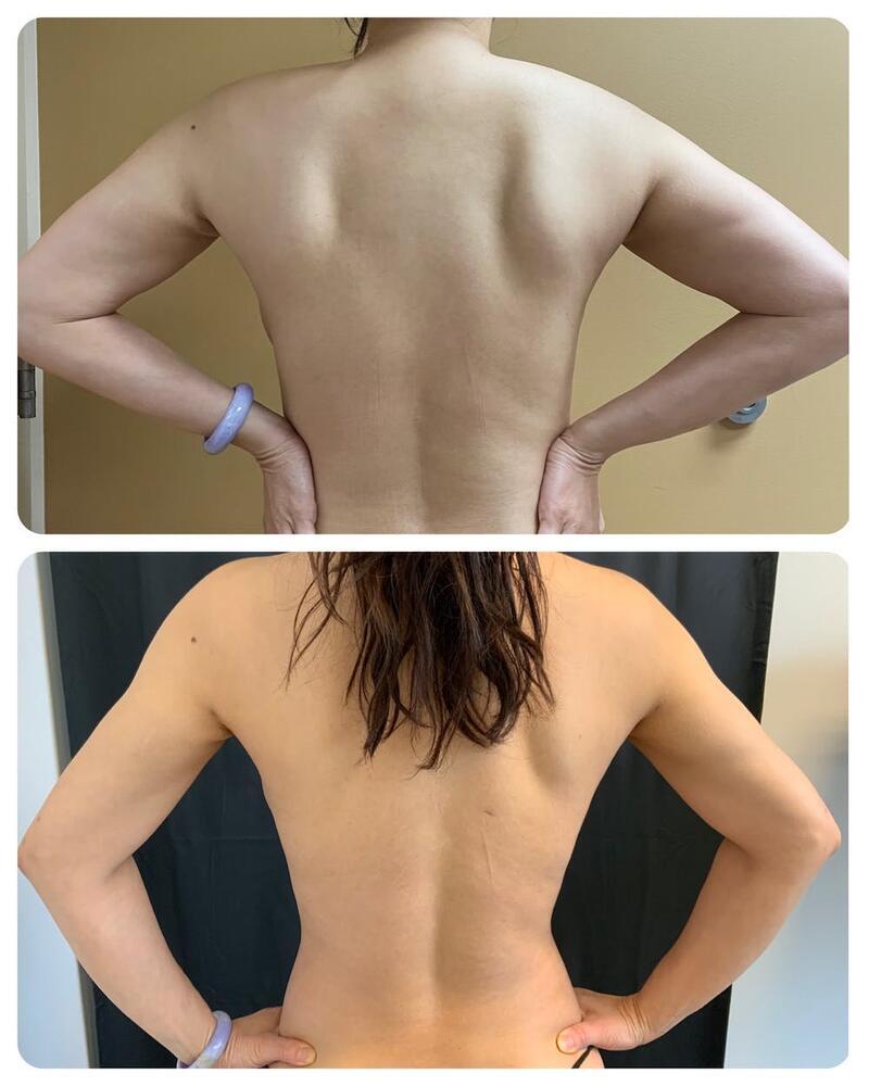 Arm Liposuction Before & After Image