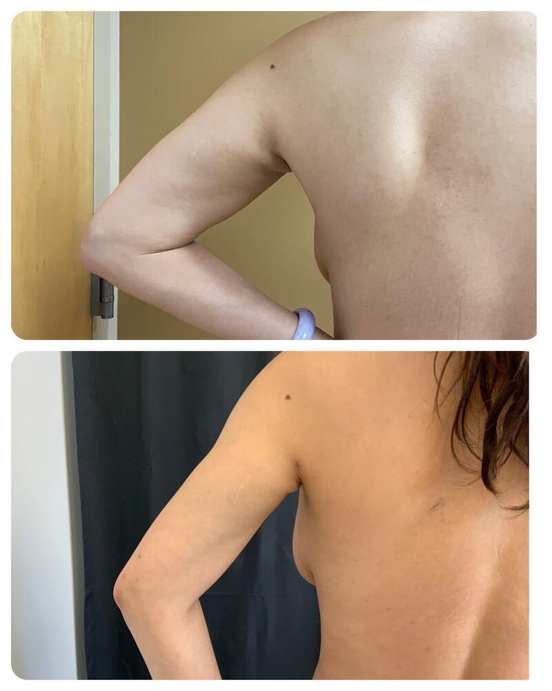 Arm Liposuction Before & After Image