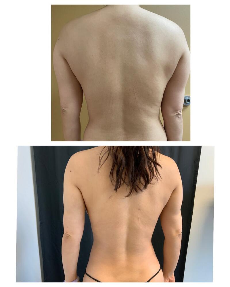 Arm Liposuction Before & After Image