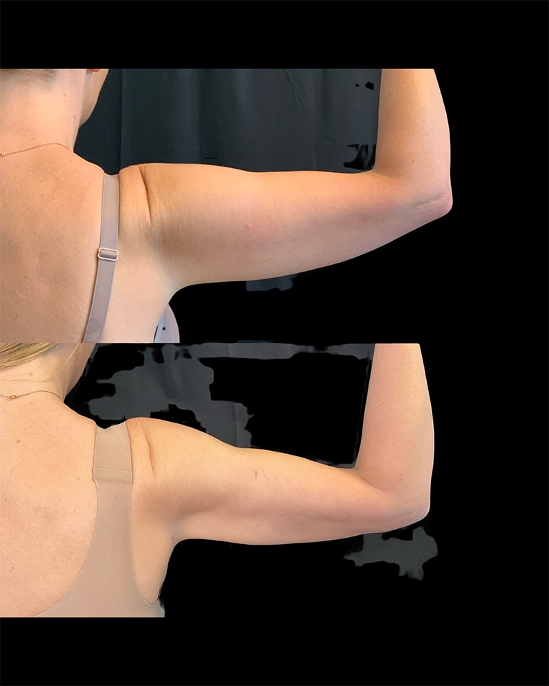 Arm Liposuction Before & After Image