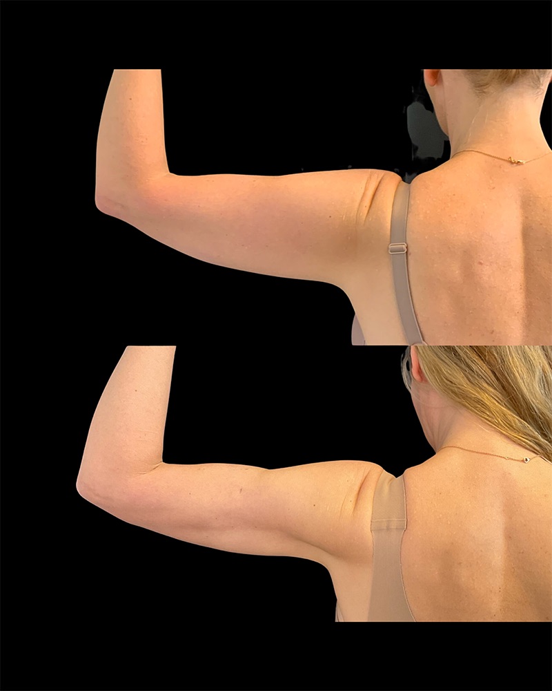 Arm Liposuction Before & After Image