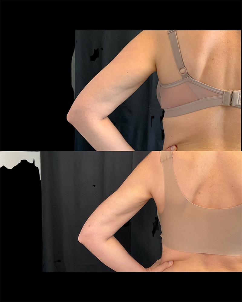 Arm Liposuction Before & After Image