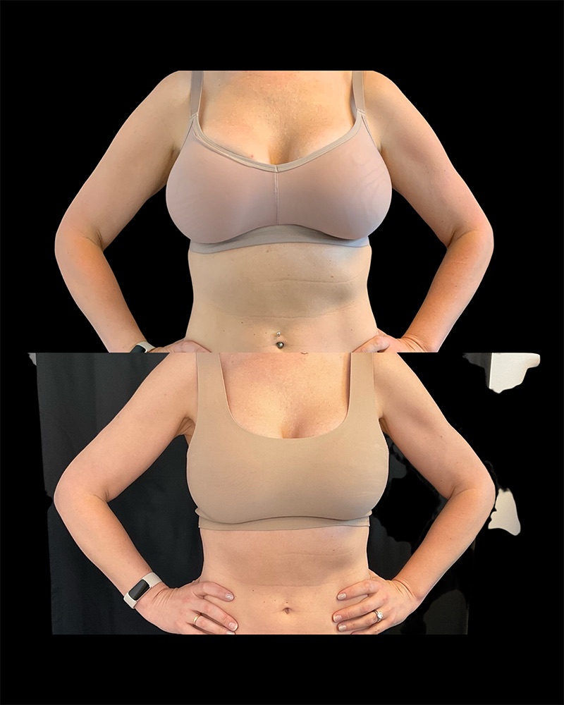 Arm Liposuction Before & After Image