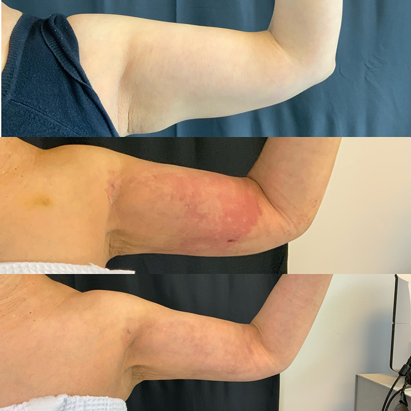 Arm Liposuction Before & After Image