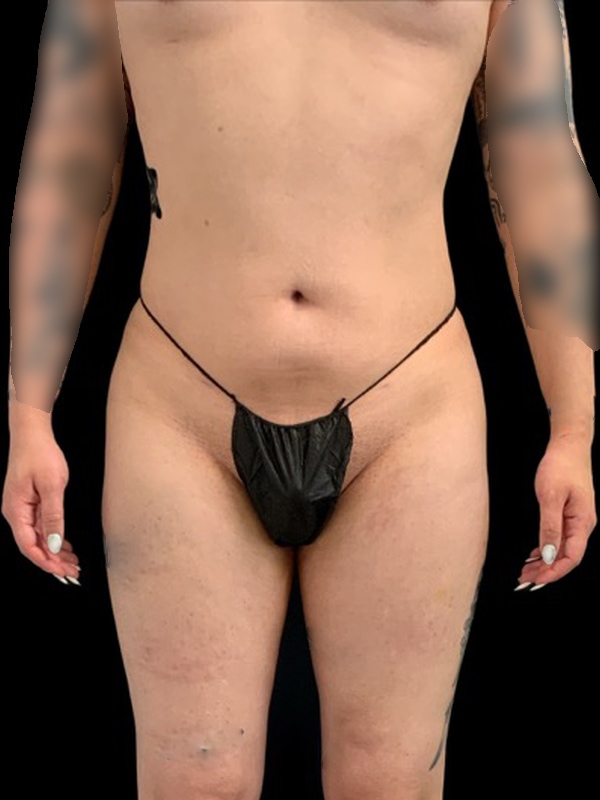 Arm Liposuction Before & After Image