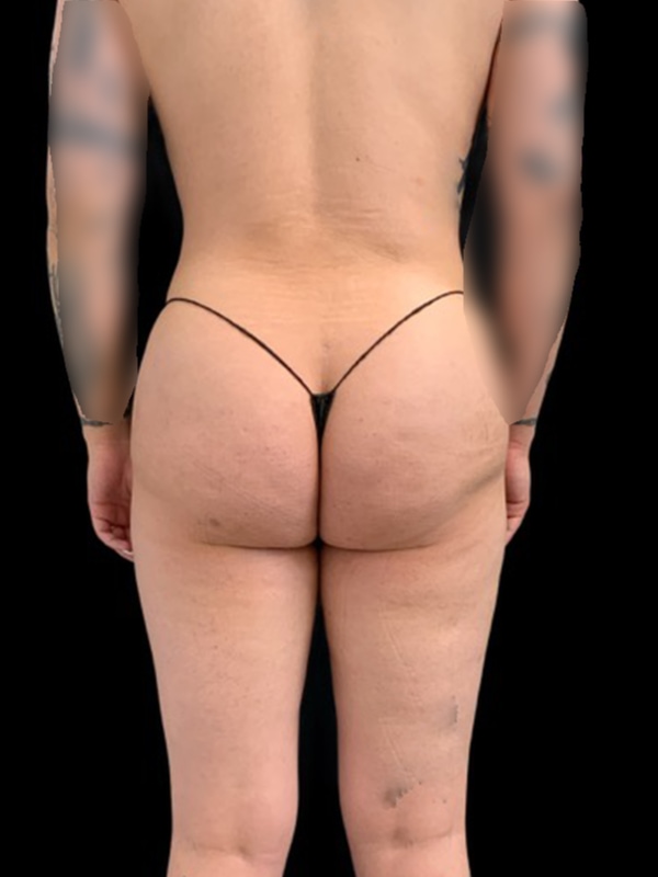Arm Liposuction Before & After Image
