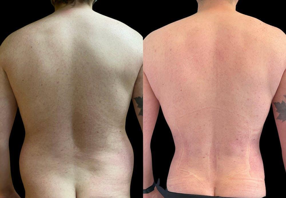 Back Liposuction Before & After Image