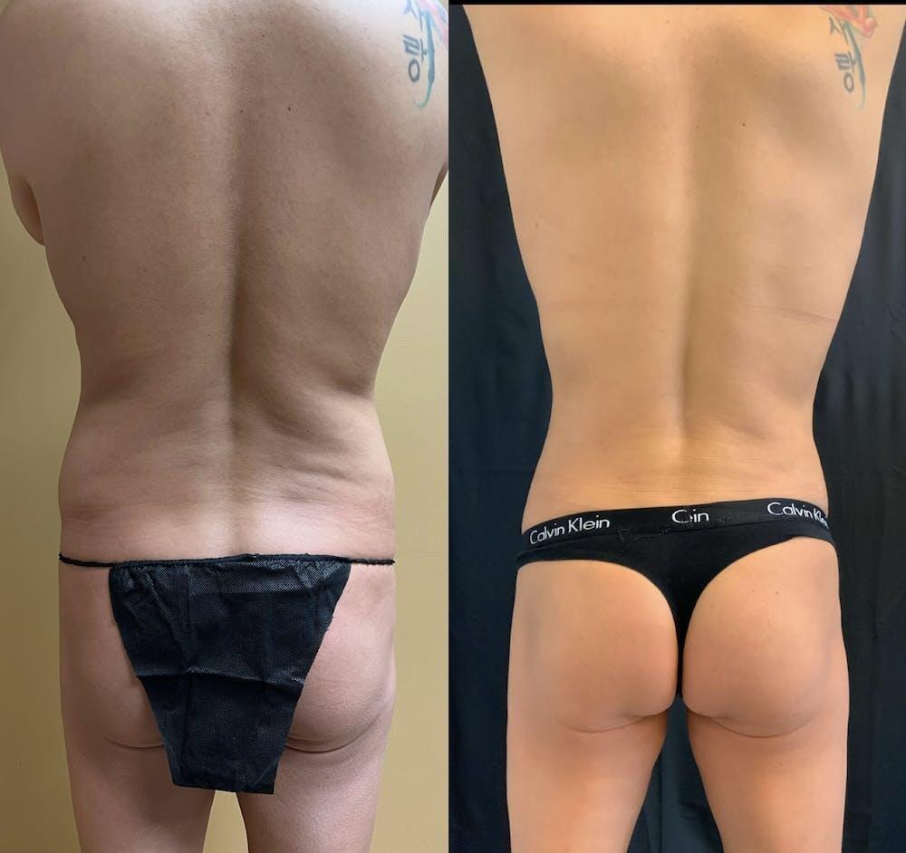 Back Liposuction Before & After Image