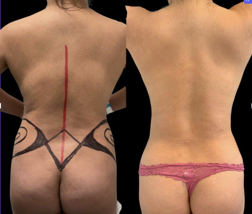 Back Liposuction Before & After Image