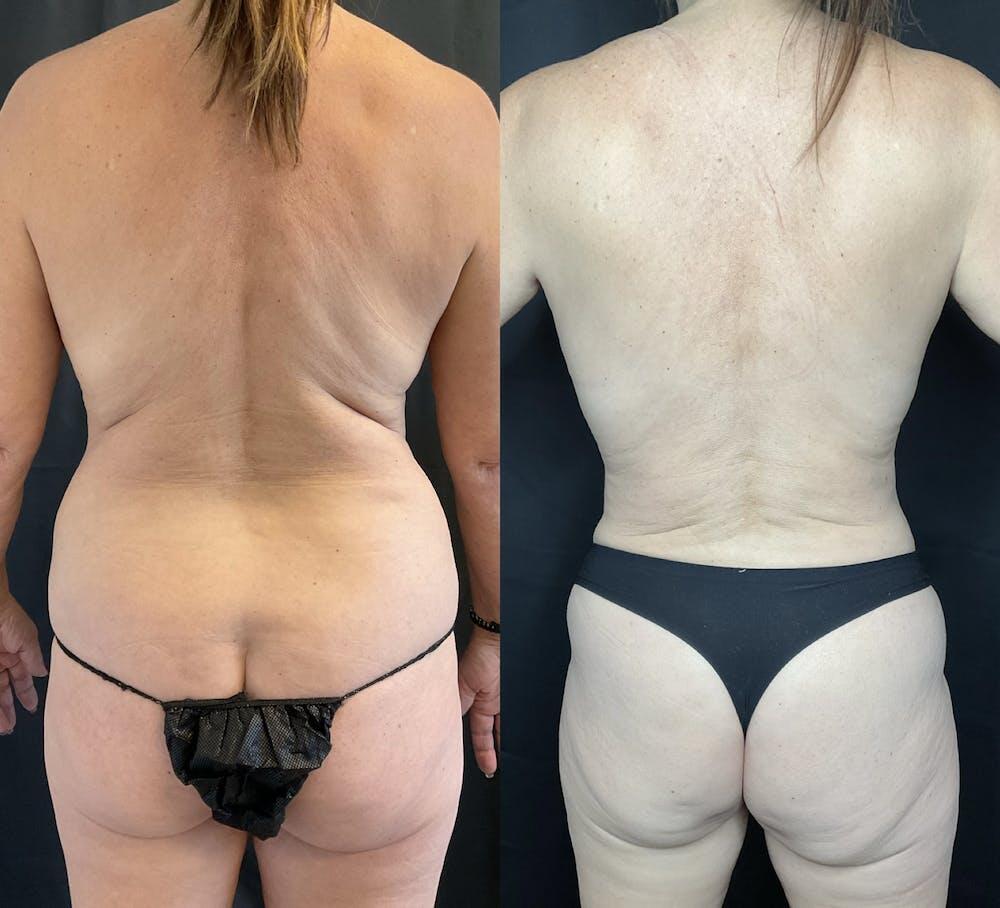 Back Liposuction Before & After Image