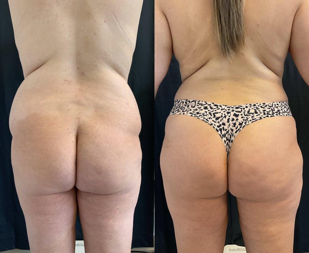Back Liposuction Before & After Image