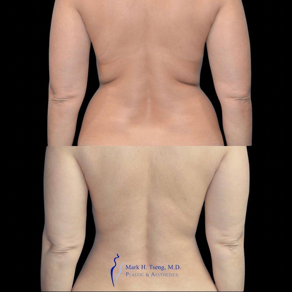 Back Liposuction Before & After Image