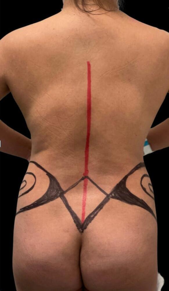 Back Liposuction Before & After Image