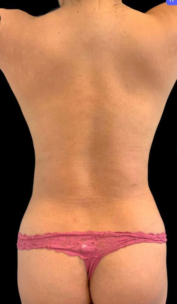 Back Liposuction Before & After Image