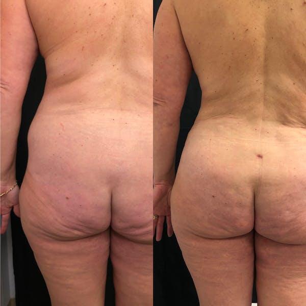 Back Liposuction Before & After Image