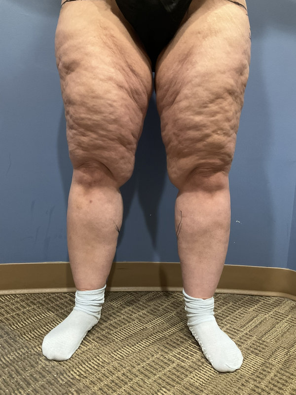 Liposuction & Body Lift Before & After Image
