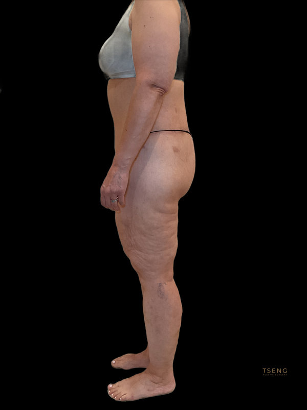 Liposuction & Body Lift Before & After Image