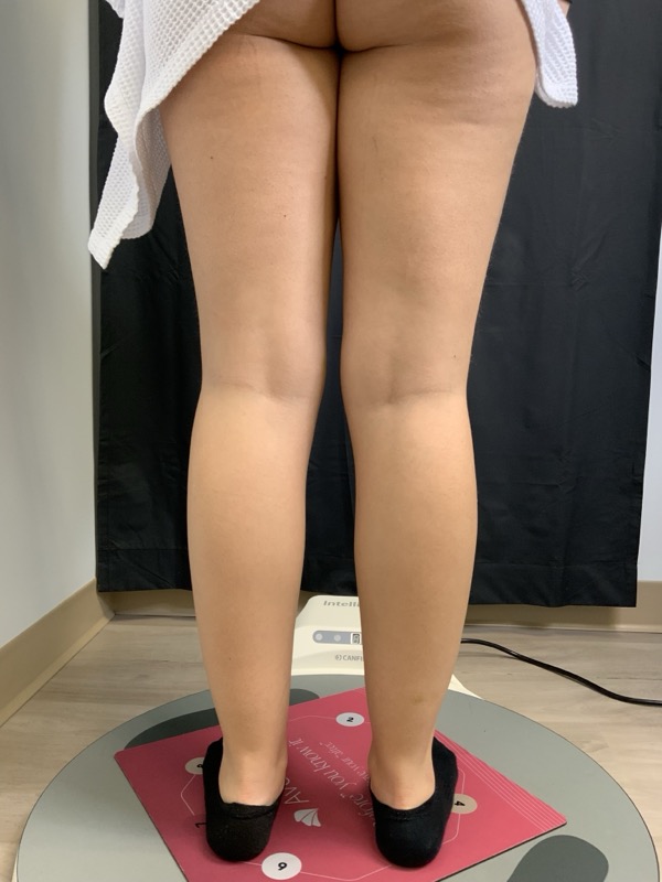 Liposuction Before & After Image