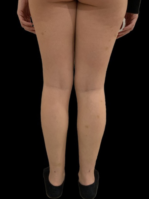 Liposuction Before & After Image