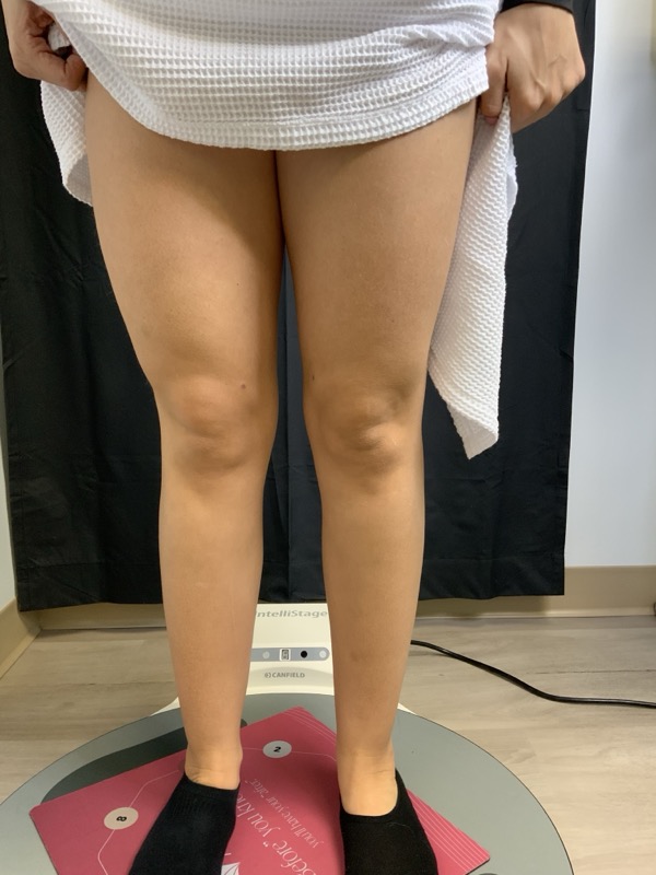 Liposuction Before & After Image