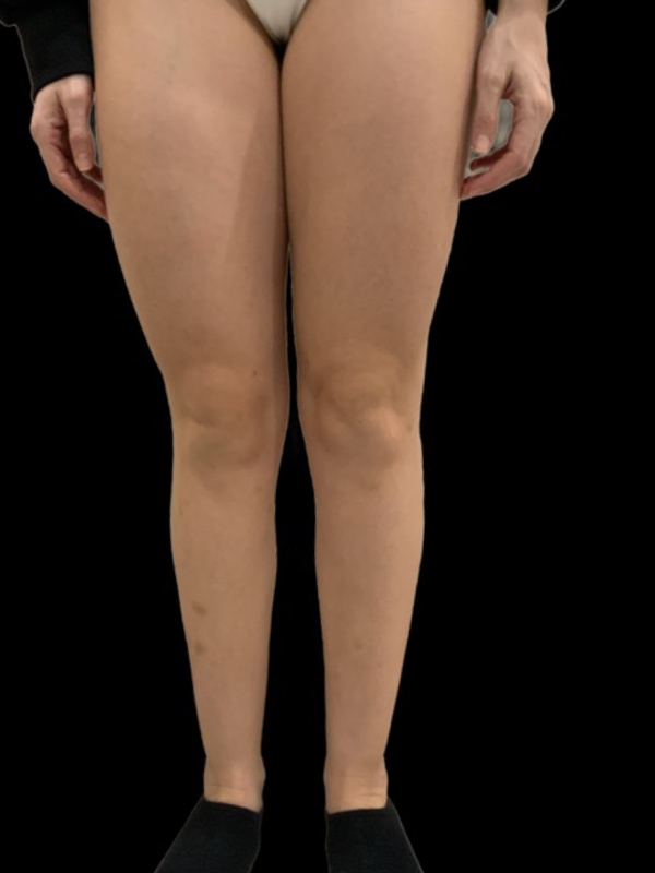 Liposuction Before & After Image