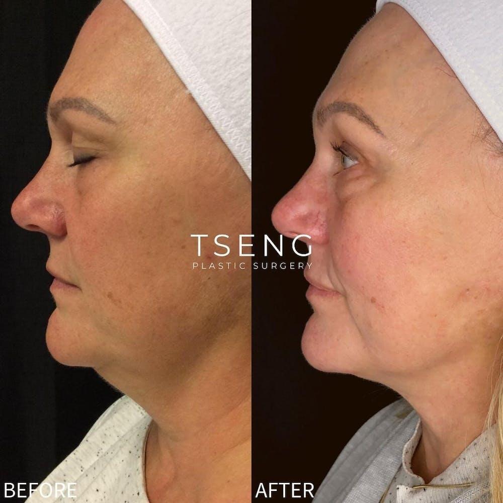 Chin Liposuction Before & After Image