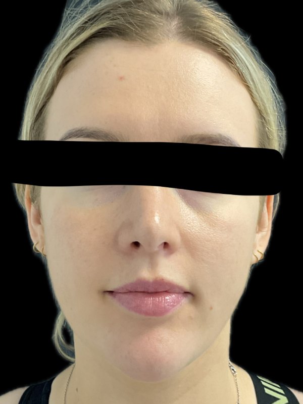 Chin Liposuction Before & After Image