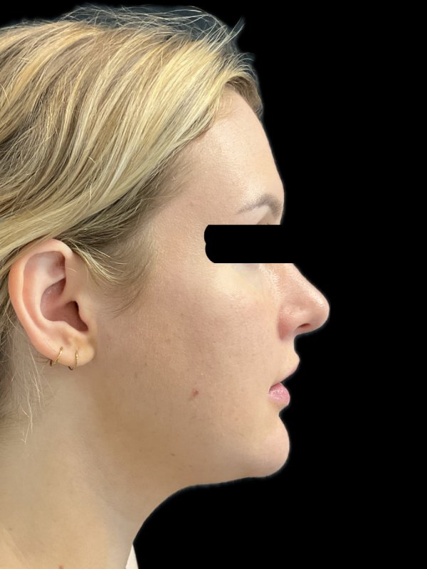 Chin Liposuction Before & After Image