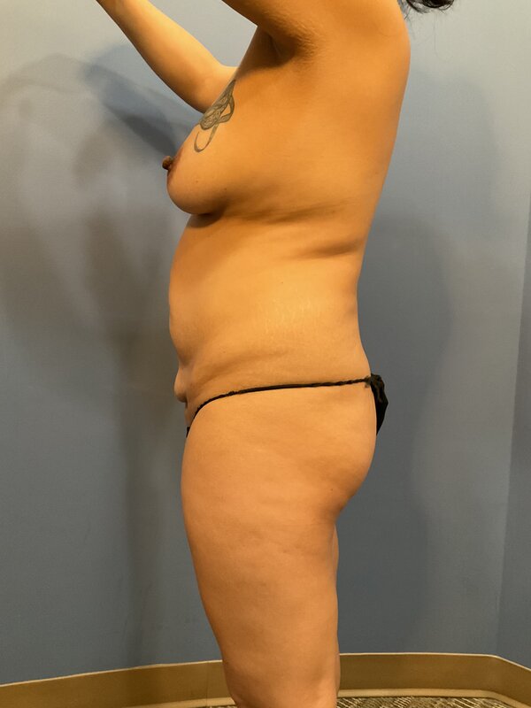 HD Abdominoplasty Before & After Image