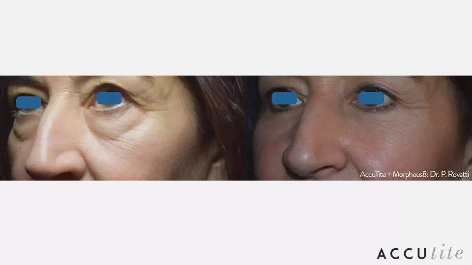 AccuTite Before & After Image