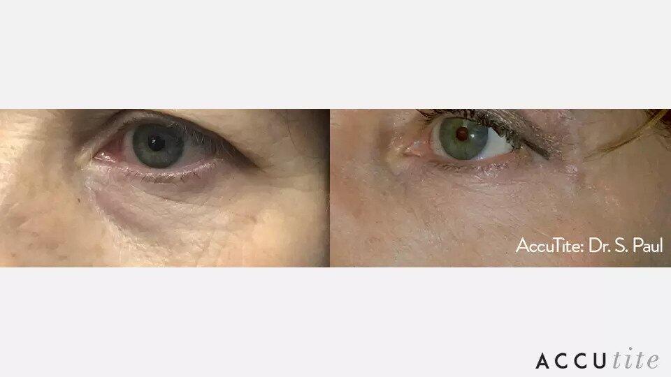AccuTite Before & After Image
