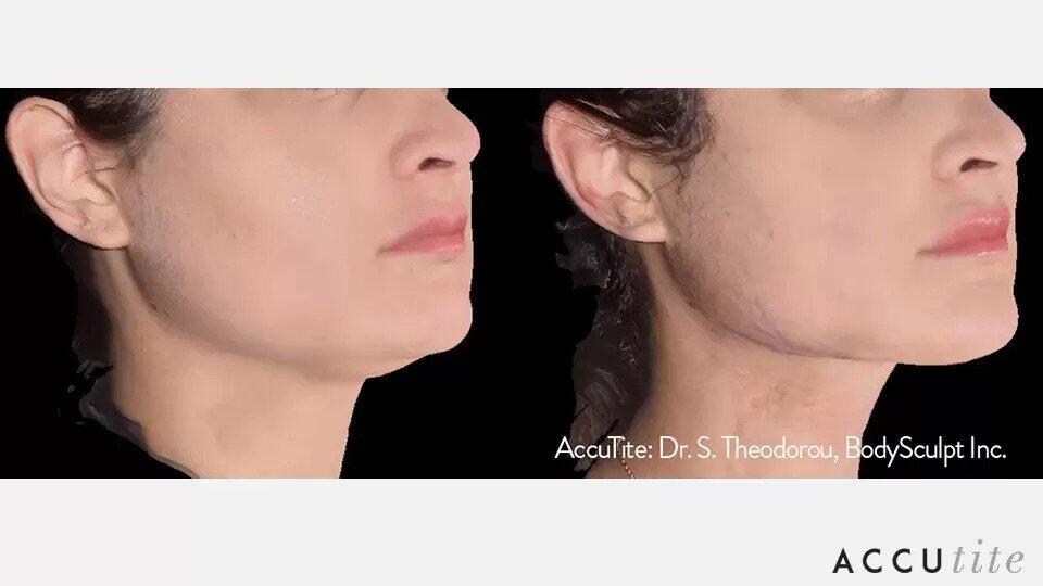 AccuTite Before & After Image