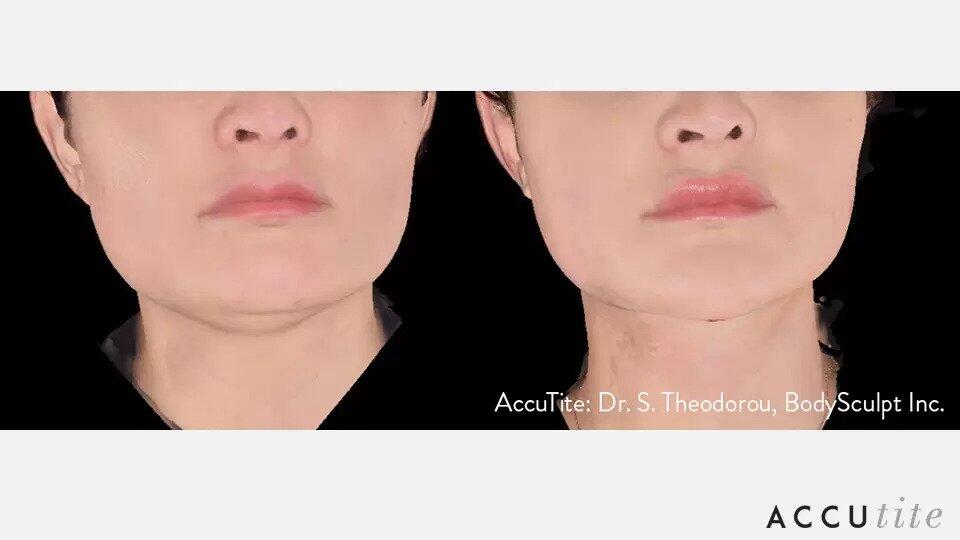 AccuTite Before & After Image