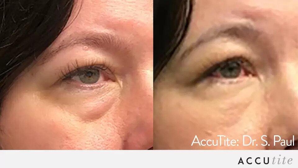 AccuTite Before & After Image