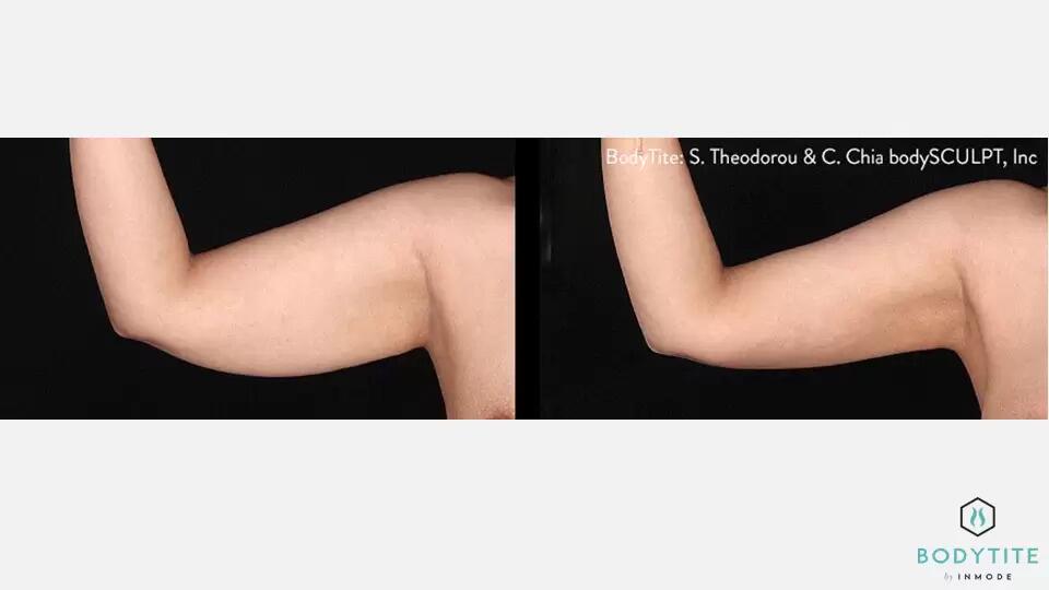 Body Sculpting Before & After Image