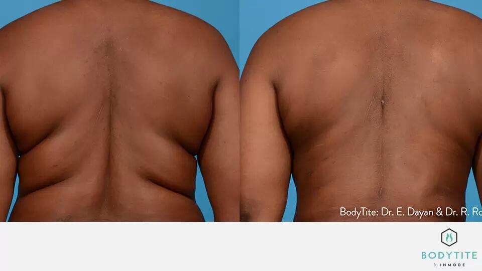 Body Sculpting Before & After Image