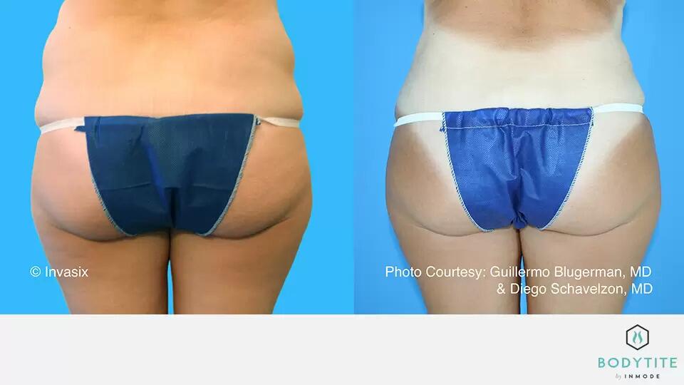 HD Body Sculpting Before & After Image
