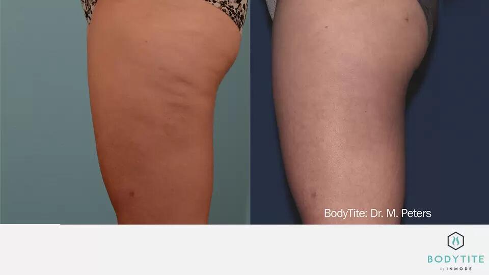 Body Sculpting Before & After Image