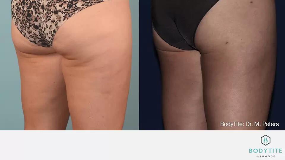 Body Sculpting Before & After Image